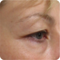 Blefaroplastia-300×300